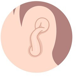 Ear Hole Repair Surgery